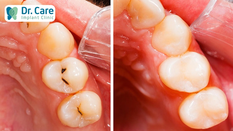 Trường hợp bảo tồn răng hàm bị sâu