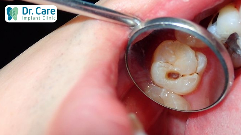 Vì sao răng hàm thường bị sâu?