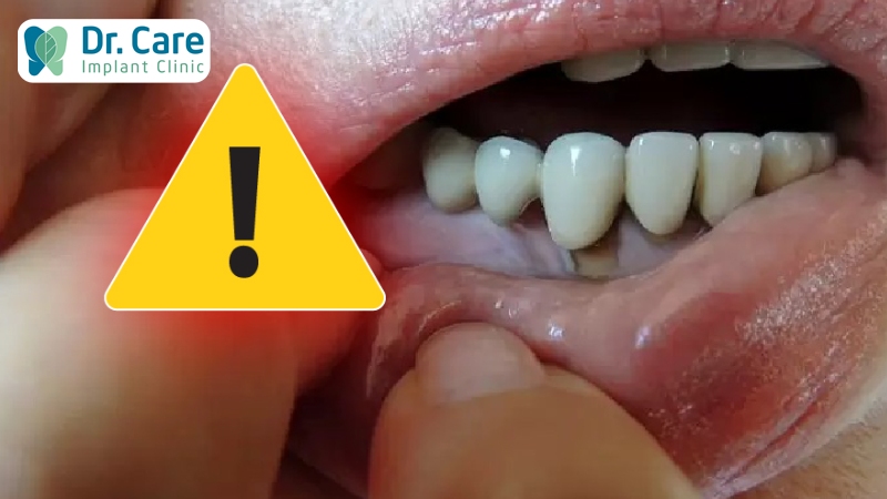 Vì sao bị đau nhức kéo dài sau khi trồng răng sứ?