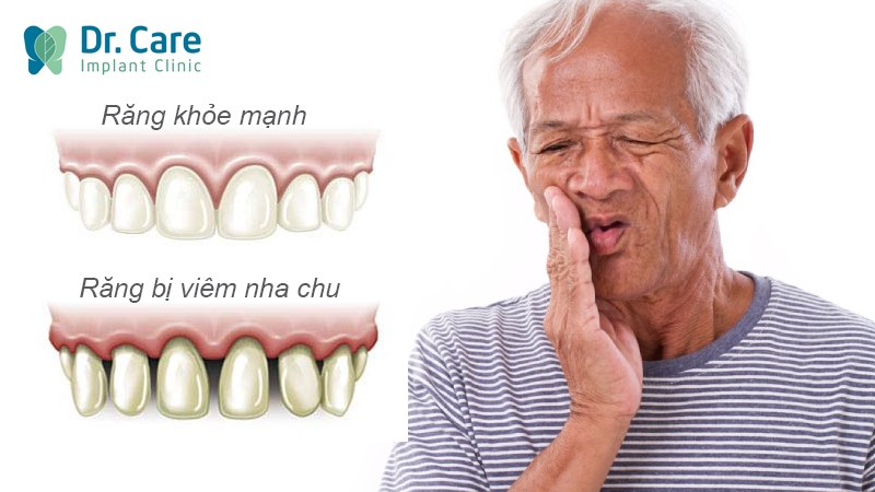 Tại sao viêm nha chu lại gây rụng răng?