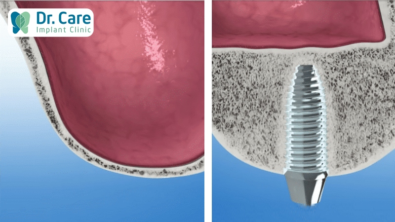 Nâng xoang bao lâu thì cấy ghép Implant được?