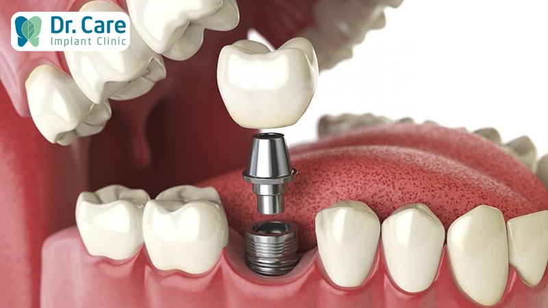 Cấy ghép Implant phục hồi răng số 6