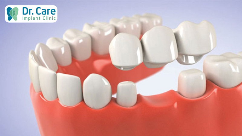 Cầu răng sứ là gì? Trường hợp cần sử dụng cầu răng sứ