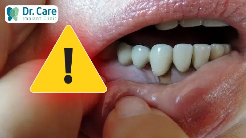 5 Nguyên nhân phổ biến khiến răng sứ bị lung lay