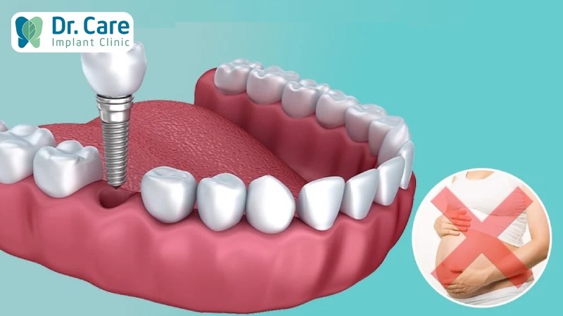Những trường chống chỉ định trồng răng sứ vĩnh viễn trên Implant