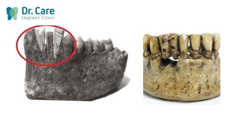 Nguồn gốc lịch sử của răng Implant 