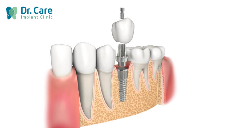 Vì sao trồng răng Implant được gọi là trồng răng sứ vĩnh viễn?