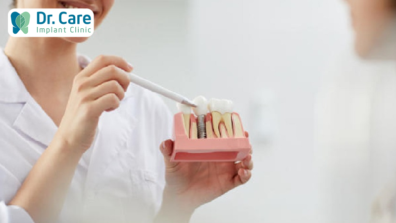 Lưu ý cách vệ sinh răng miệng sau cấy ghép Implant