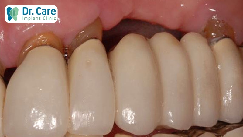 Vì sao cầu răng sứ khiến 2 răng bên cạnh bị yếu đi?