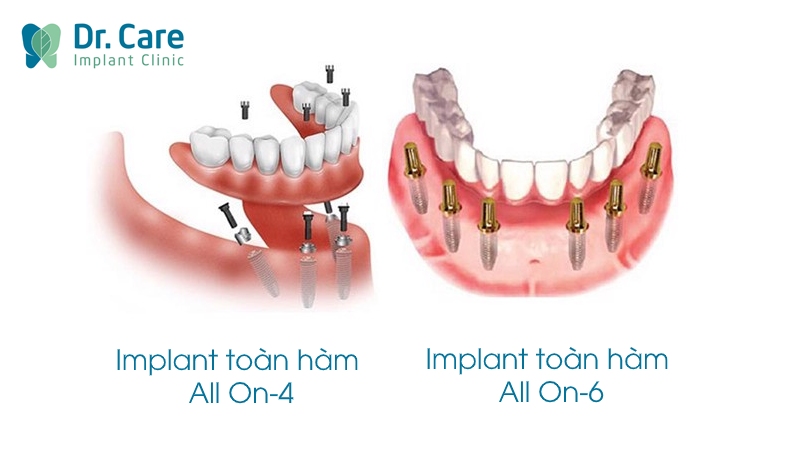 Trồng răng Implant nguyên hàm loại nào tốt nhất?