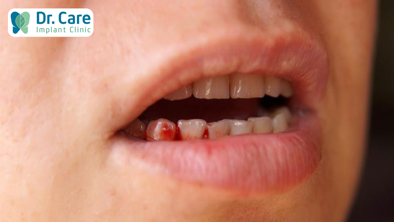 Chảy máu nướu răng khi đánh răng có nguy hiểm không?