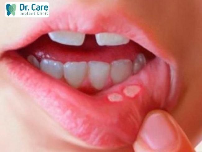 Chế độ ăn uống và vệ sinh răng miệng có thể làm nhiệt miệng nặng hơn.