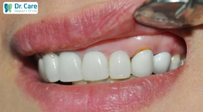 Biểu hiện răng sứ bị hư