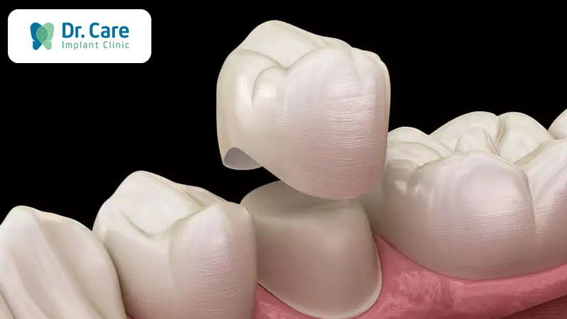 Gắn mão răng sứ là khâu cuối của quy trình bọc răng sứ