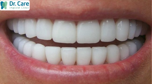Bọc răng sứ giúp răng đều, trắng, sáng