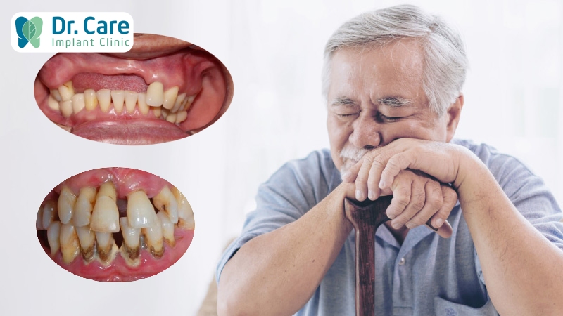 Đối tượng trồng được răng Implant toàn hàm?