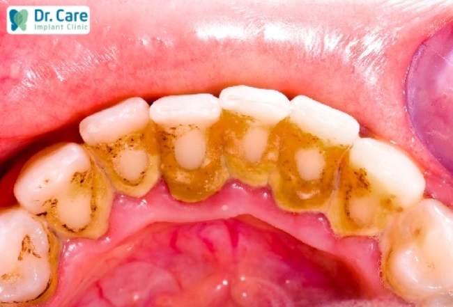 Vàng răng, cao răng là một trong những hậu quả đánh răng sai cách