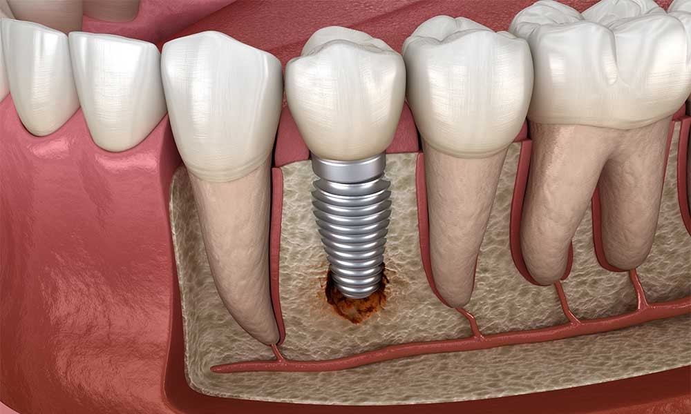 Trụ răng Implant bị đào thải