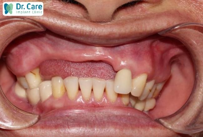 Khả năng bị tiêu xương hàm khi mất nhiều răng liên tiếp