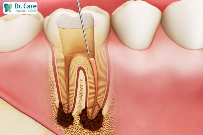 Bọc răng sứ khi chưa điều trị dứt điểm viêm tủy