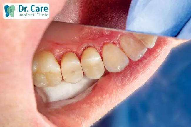 Các bệnh lý về răng miệng chưa điều trị dứt điểm