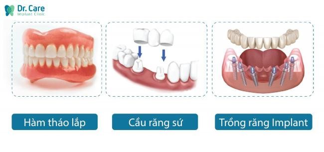 Các phương pháp trồng răng giả