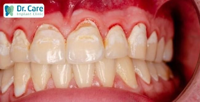 Vệ sinh răng miệng không sạch dẫn đến vôi răng gây viêm nhiễm dễ chảy máu