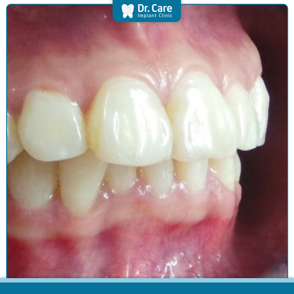 Các trường hợp răng hô thường gặp