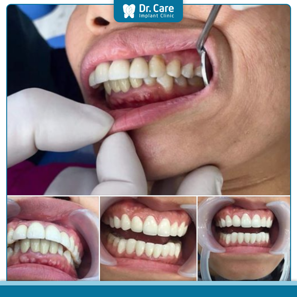 Trường hợp nào thích hợp để bọc răng sứ cải thiện tình trạng răng hô?