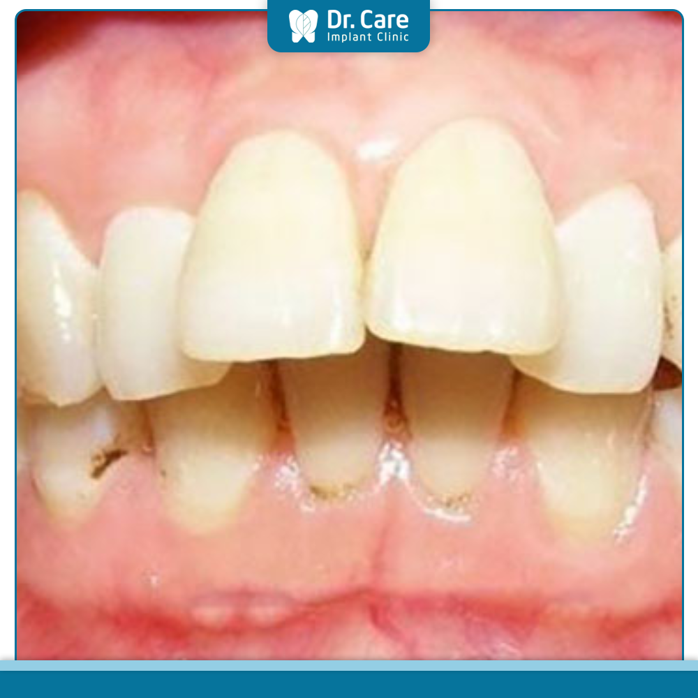 Hệ lụy của răng hô nếu không điều trị kịp thời