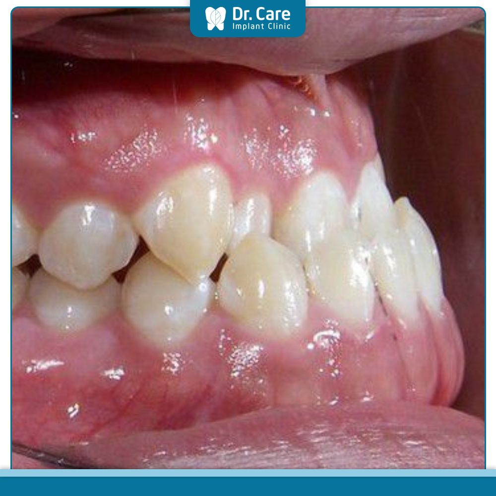 Các trường hợp răng hô thường gặp