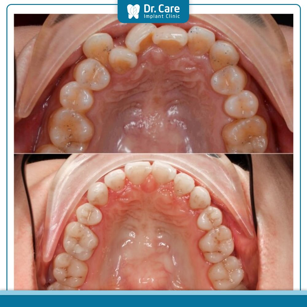 Răng khấp khểnh nếu không được vệ sinh lâu ngày, mảng bám tích tụ có thể gây viêm nha chu