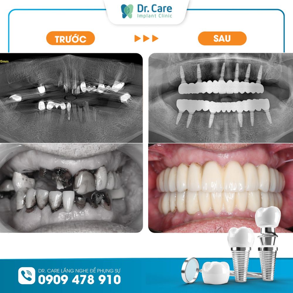 Khách hàng trồng răng Implant và phục hình răng sứ trên Implant toàn hàm tại Dr. Care