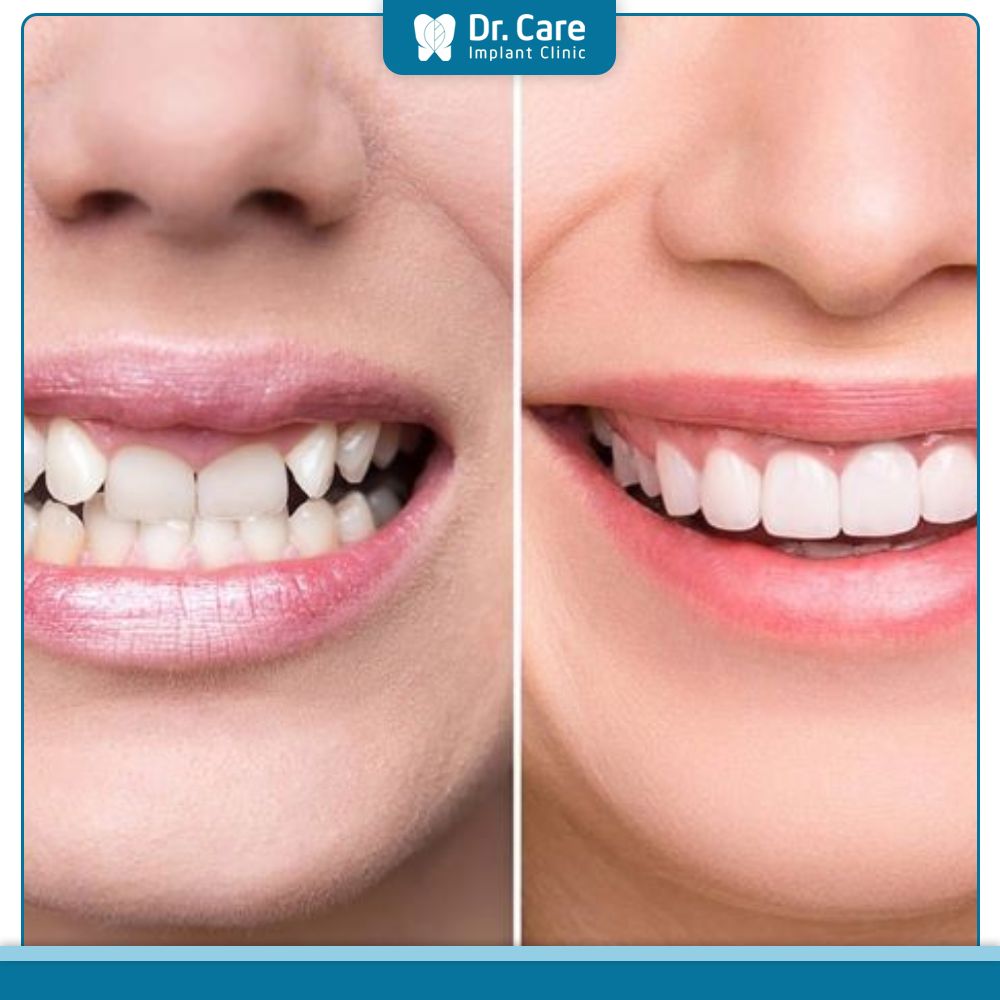 Bọc sứ răng khểnh không ảnh hưởng đến sức khỏe nếu được thực hiện tại các cơ sở Nha khoa uy tín - chất lượng
