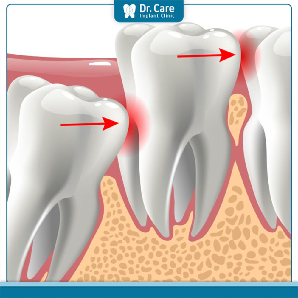 Nguyên nhân phổ biến gây đau nhức răng