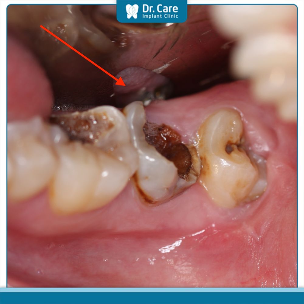 Nguyên nhân phổ biến gây đau nhức răng