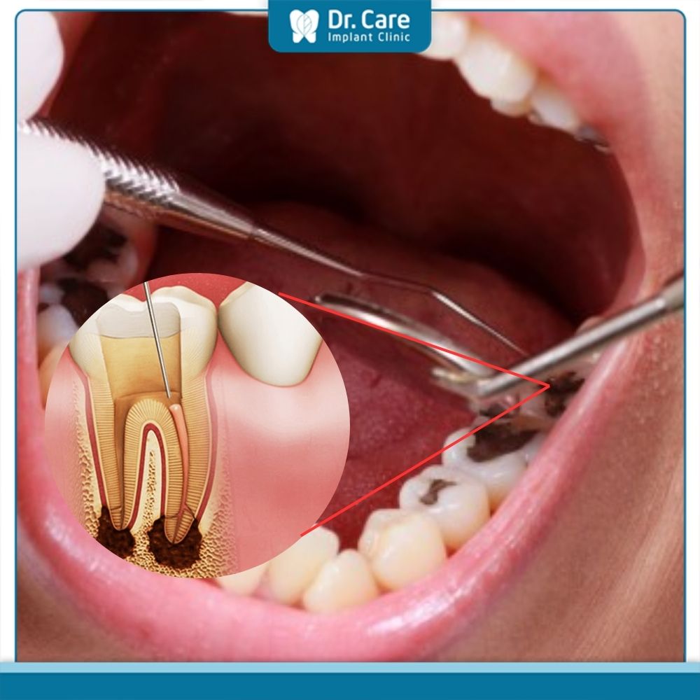 Tại sao răng đã lấy tủy vẫn bị đau răng?