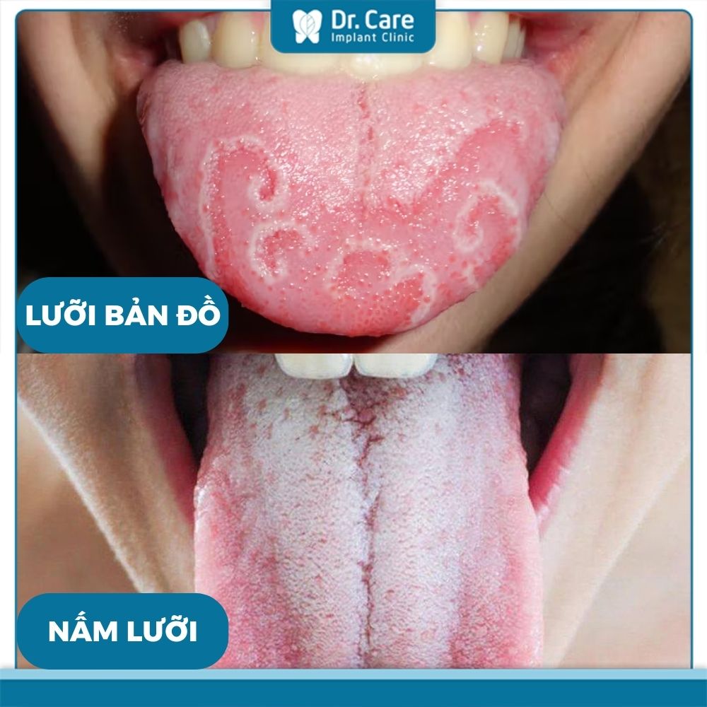 Phương pháp chẩn đoán bệnh lưỡi bản đồ