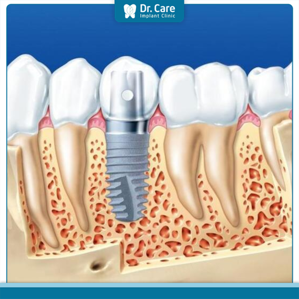 Điều kiện để thực hiện trồng răng Implant