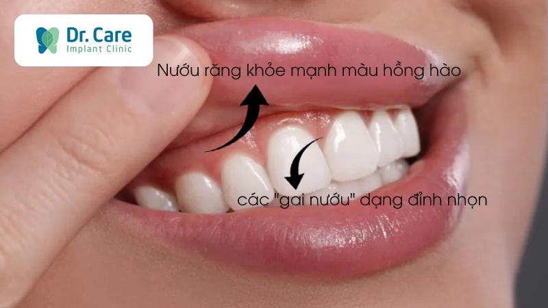 Nướu răng khỏe mạnh có những đặc điểm gì?