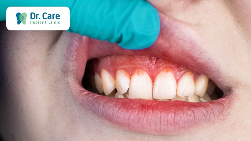 Các bệnh về nướu răng nếu không được điều trị kịp thời có nguy hiểm không?