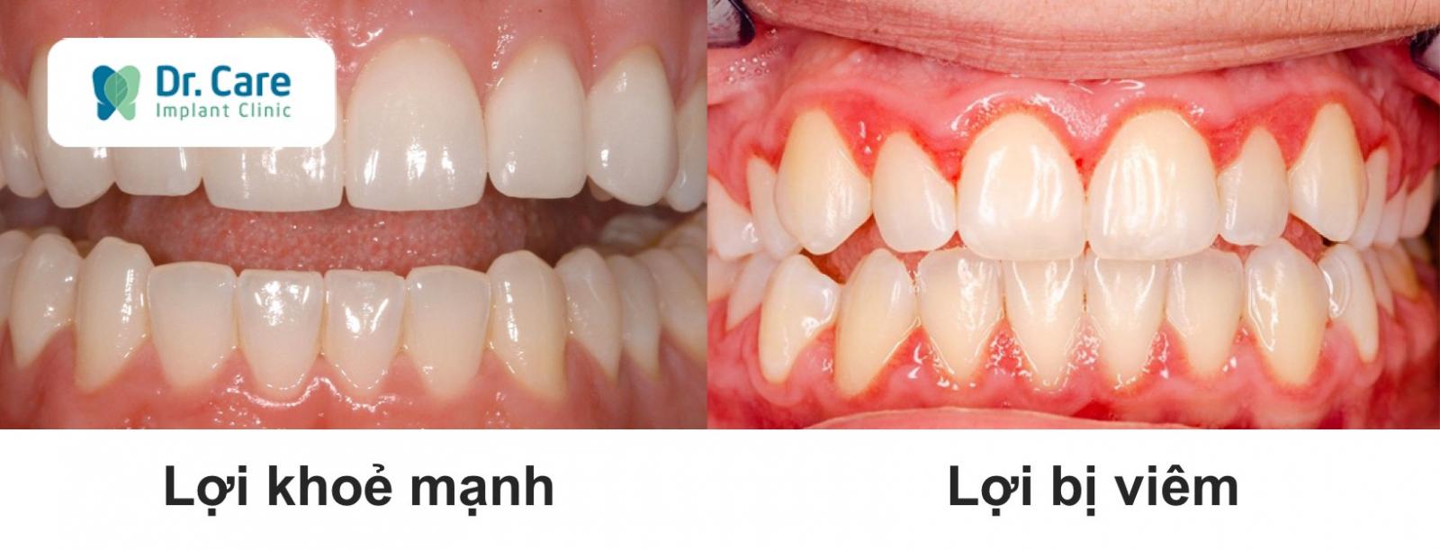 Điều trị khi có dấu hiệu đầu tiên của bệnh nướu răng