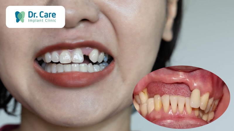 Mất răng có làm ảnh hưởng đến nướu răng không?