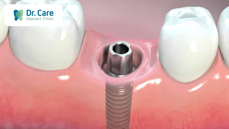 Nên điều trị sâu răng đến tủy trước khi trồng răng Implant không?