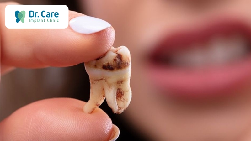 Sâu răng đến tủy có tăng nguy cơ mất răng vĩnh viễn không?