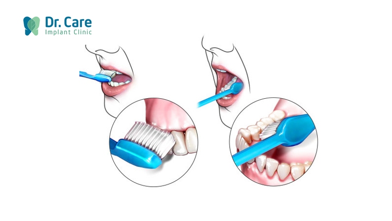 Cách ngăn ngừa tình trạng sâu răng đến tủy