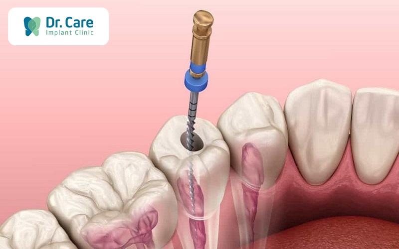 Điều trị sâu răng vào tủy có đau không?