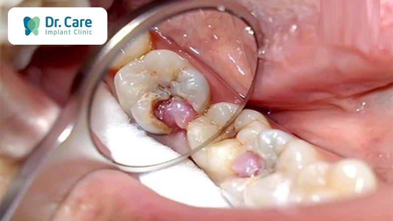 Dấu hiệu răng sâu vào tủy là gì? Các giai đoạn nhận biết răng sâu vào tủy