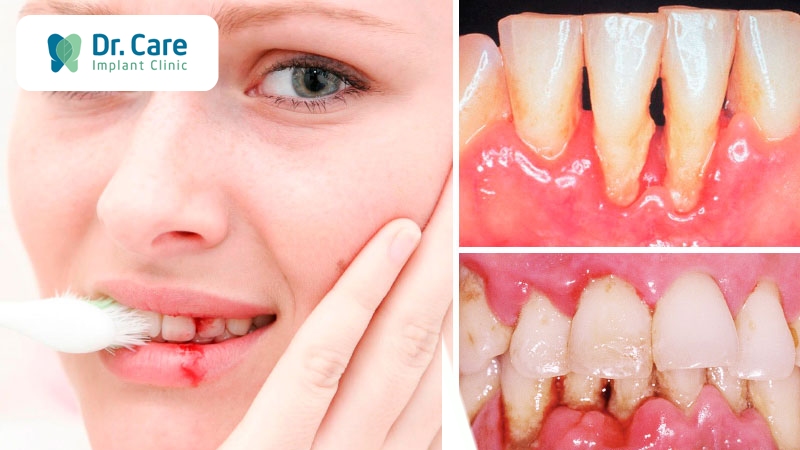 Các biến chứng khi bị sâu răng vào tủy