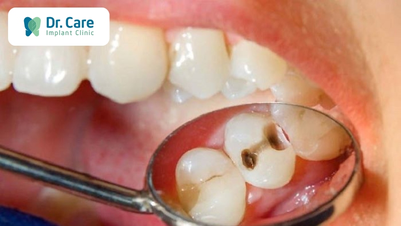 Sâu răng là gì? Sâu răng do nguyên nhân từ đâu?